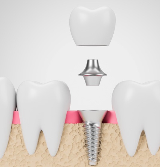 Crown, abutment and dental implant in Jacksonville, FL