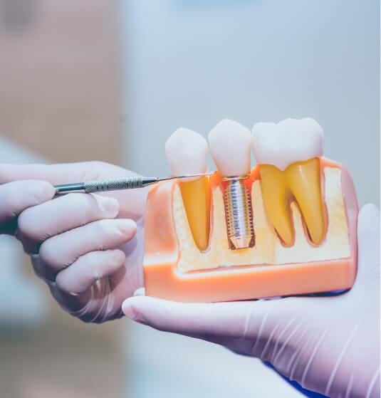 Dentist holding a model of dental implants in Jacksonville