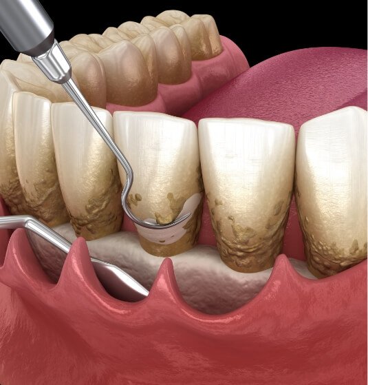 Animated dental tools removing plaque from teeth during gum disease treatment
