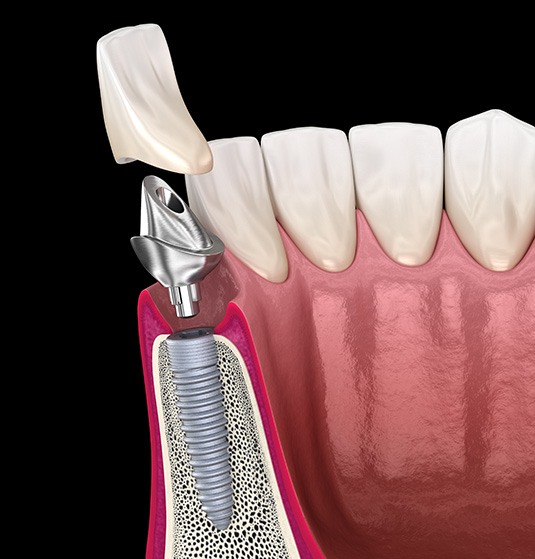 a digital illustration showing the parts of the dental implant